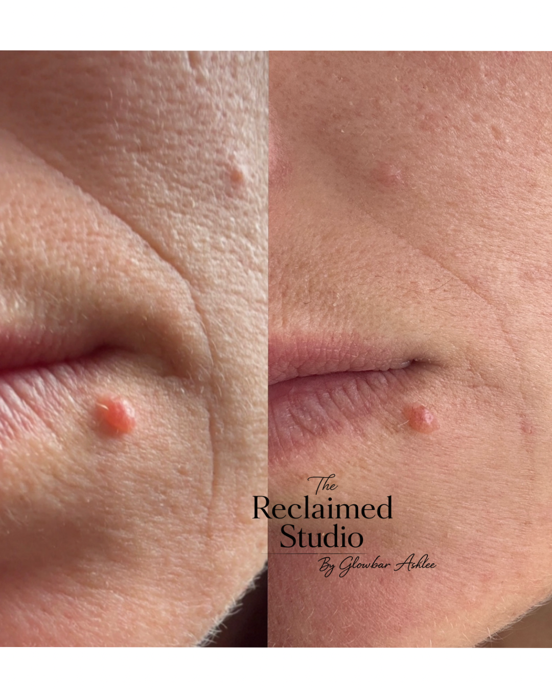 Smile lines after two inkless revision sessions. Texture much less deep, lines are softening.