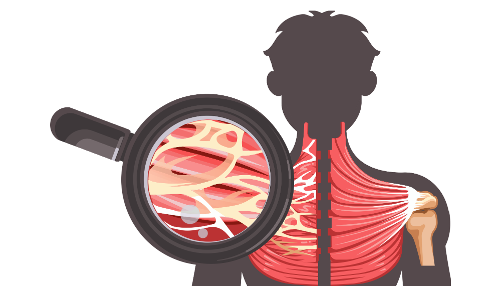 Shift Mind Body Spirit_Myofascial Release Therapy_Berkeley, CA_Medical illustration showing a person with a magnifying glass highlighting muscle tissue in the shoulder and upper back area.