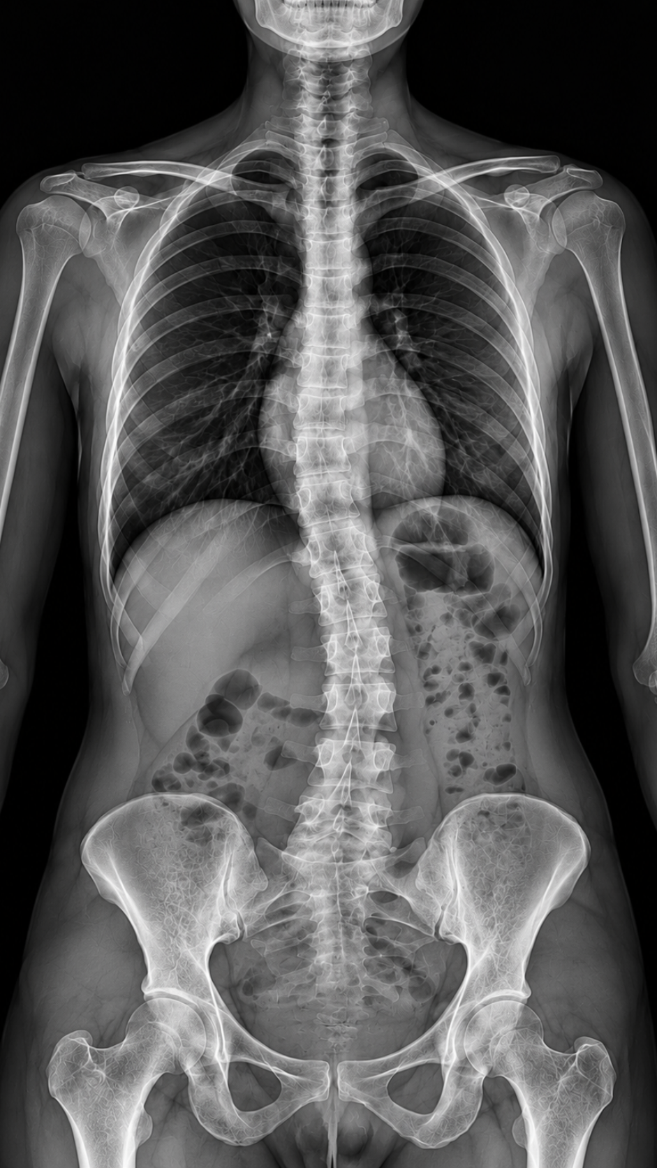Front-view full-spine radiograph showing the cervical spine, torso, and pelvis.