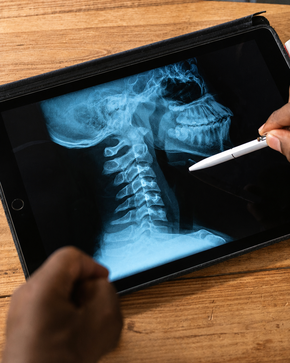 When Is Less More? Identifying the Right Candidates for Short Fusion in Cervical Deformity Surgery