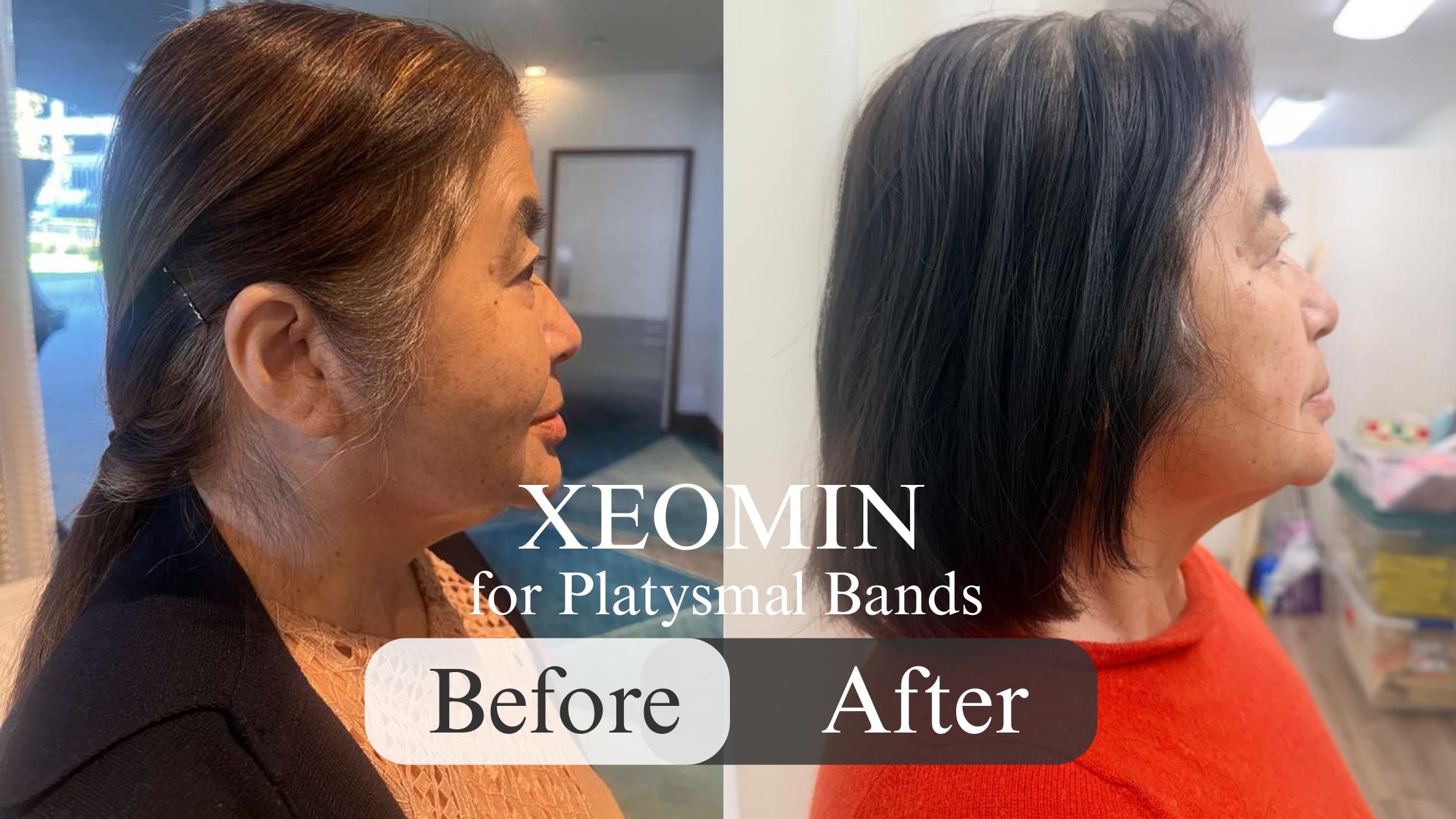 Botox &amp; Xeomin: What to Expect, When You'll See Results, and How Long They Last
