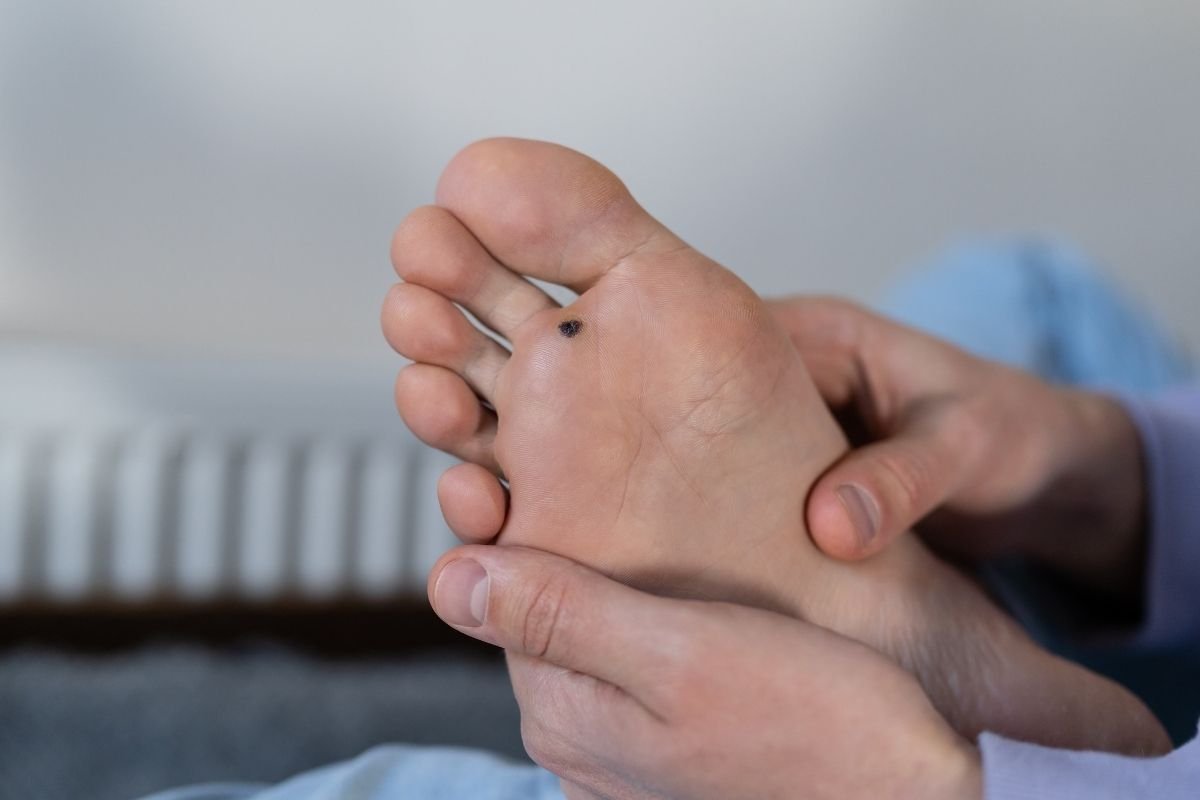 Swift Treatment for Verrucas (Plantar Warts)