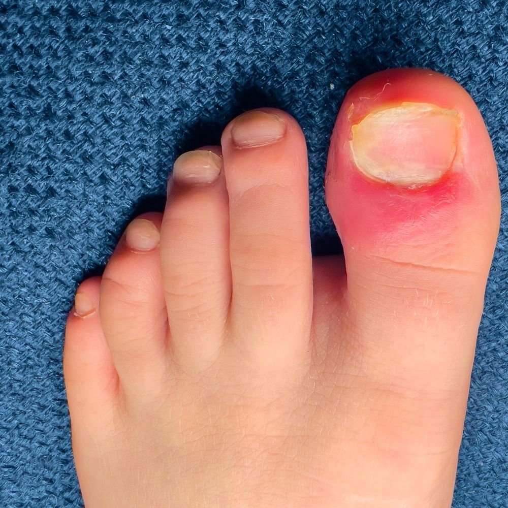 Ingrown Toenails