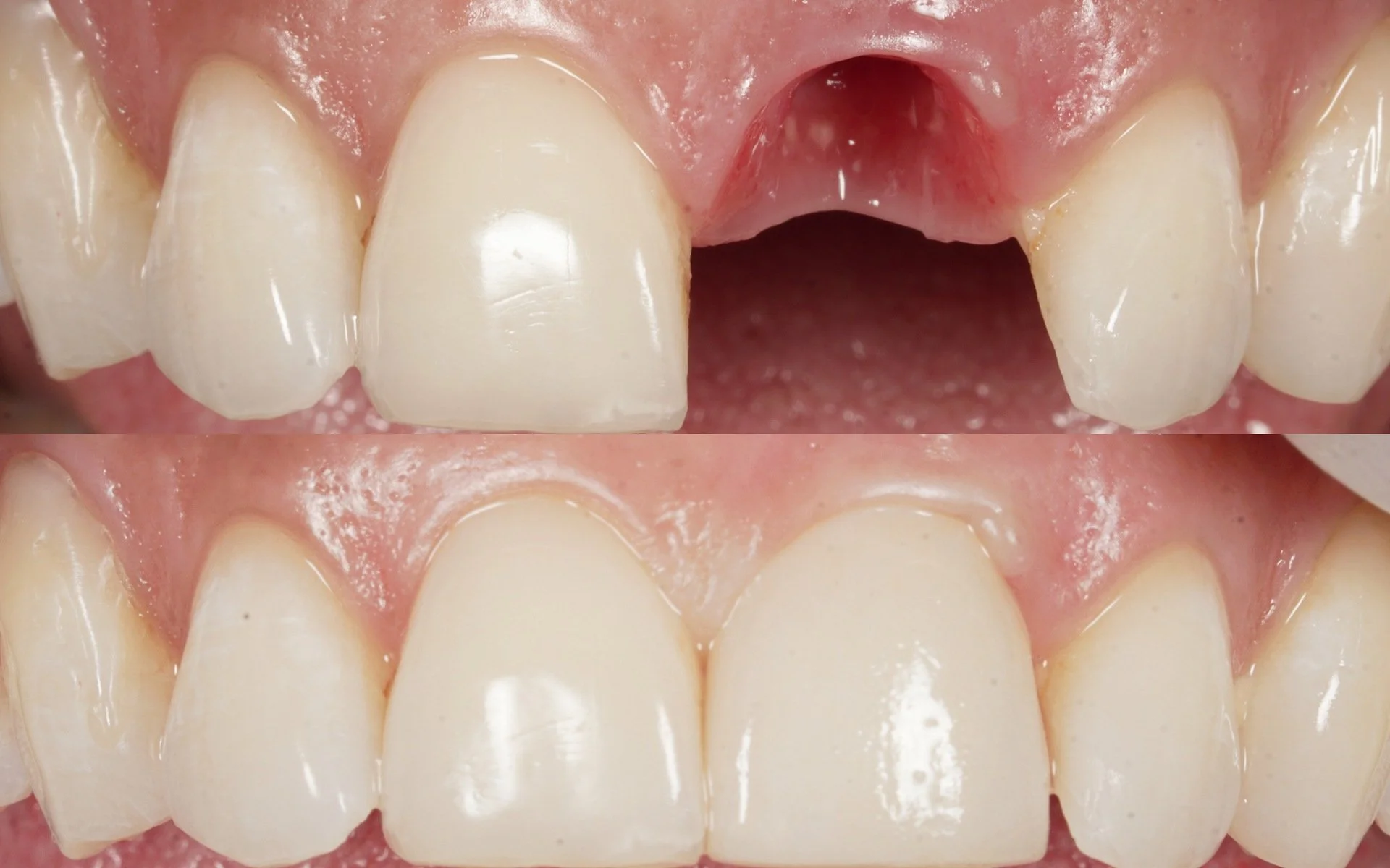 Replacement of a missing upper front tooth with a natural-looking dental implant crown. View the full case documentation at ImplantDentistryToronto.ca