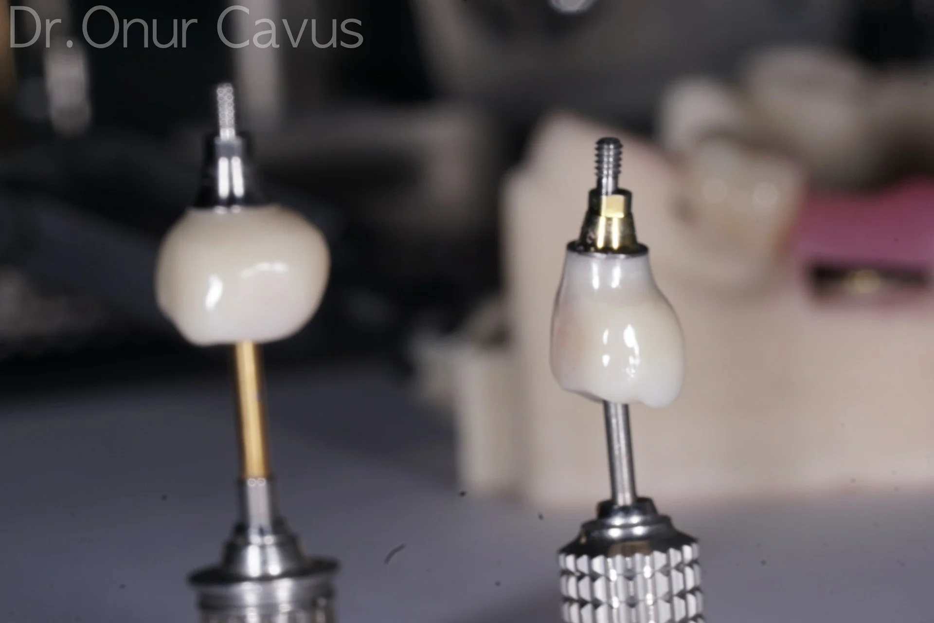 Dental implant crown restoration mounted on implant abutment