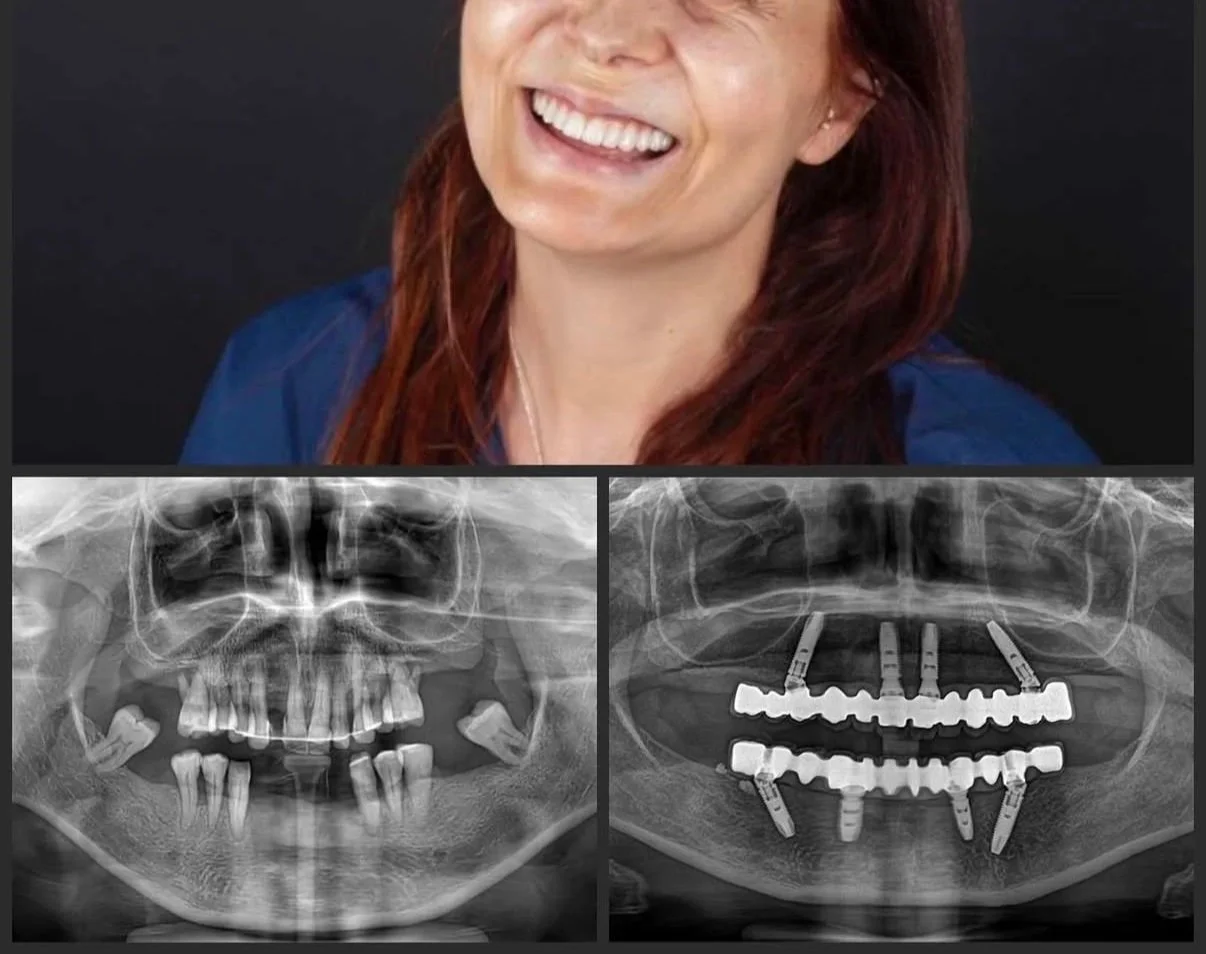 All-on-X Full Arch Implants in Toronto: A Complete Guide