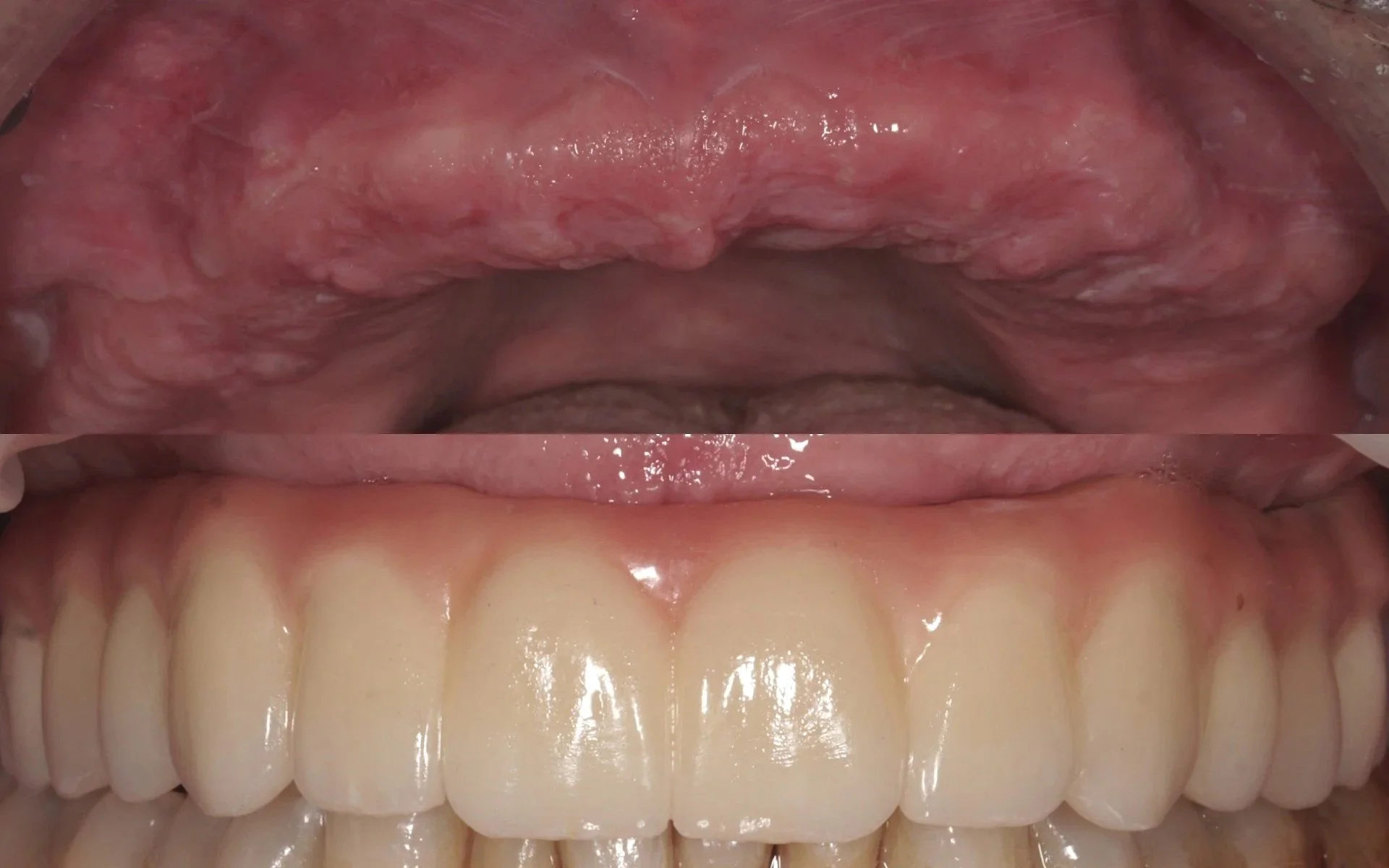 All-on-6 full arch implant restoration in the upper jaw using a monolithic zirconia prosthesis, providing a fixed, durable, and esthetic solution for complete tooth replacement.