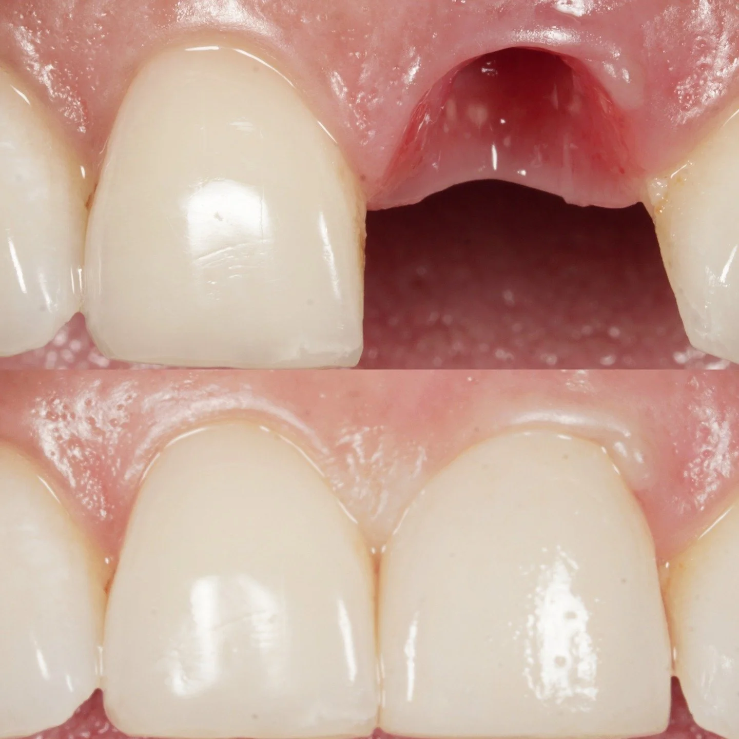 A single missing front tooth in a high smile-line restored with an immediate implant, socket gap graft, and connective tissue graft for long-term esthetic success.

Every detail &mdash; from extraction to soft-tissue contour &mdash; matters.
#implant