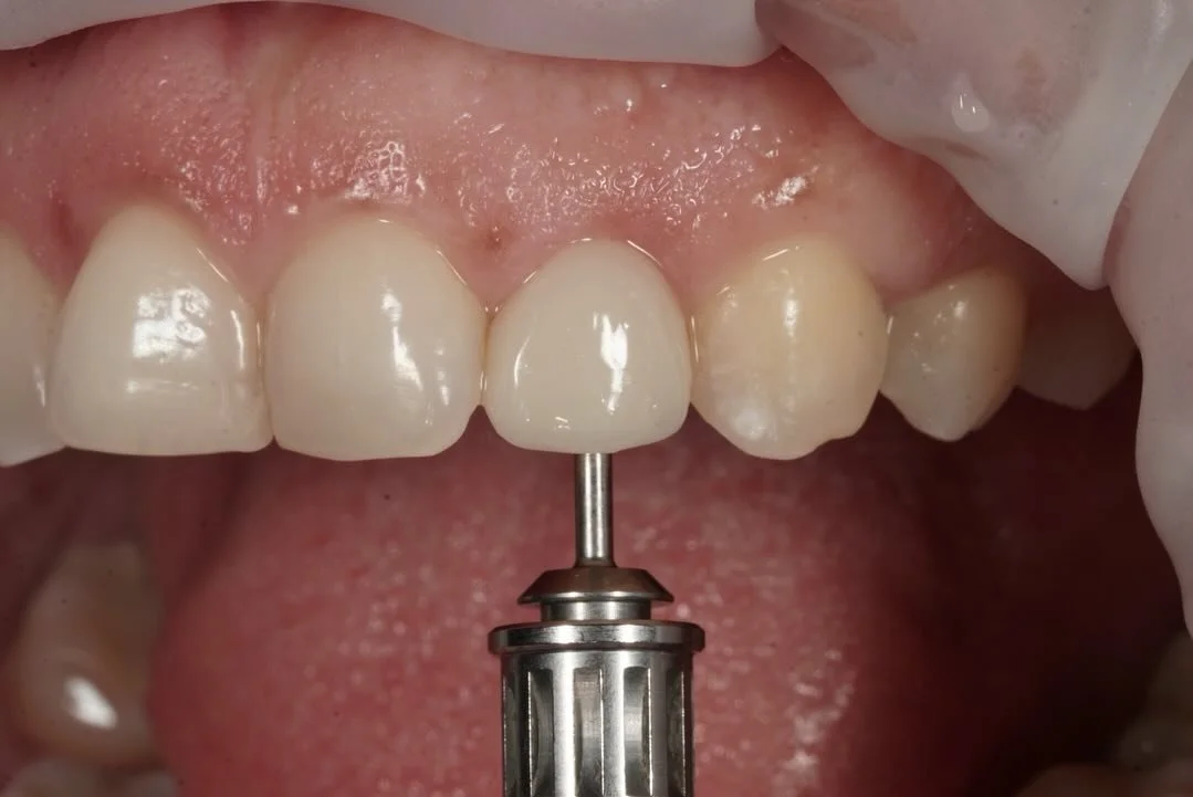 A #singleimplant case with a proper #emergenceprofile . A #provisionalcrown was fabricated following osseointegration .
#implantology #implantdentistry
