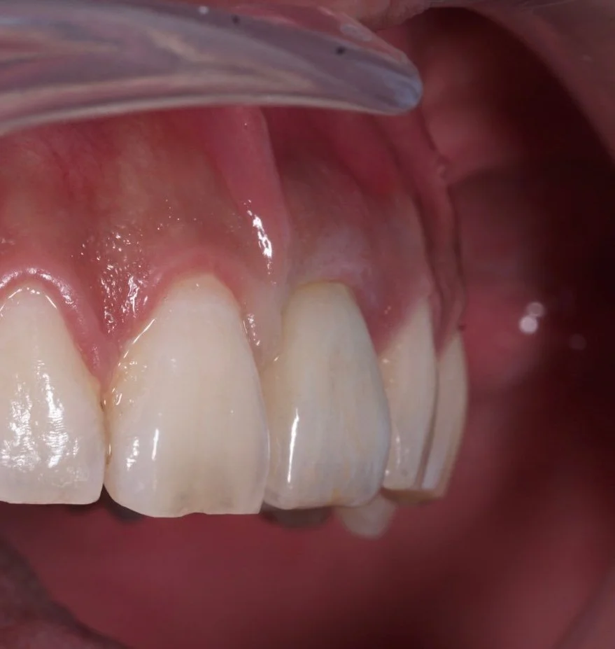 #smiletransformation by a single #dentalimplant
for broken #centralincisor 
#dentalimplants #dronurcavus #torontodentistry #implantdentistry #torontoimplantdentistry #oralsurgery #implantsurgeon