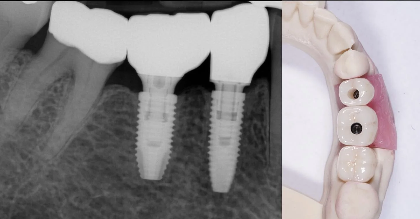 One - Year Follow-Up of monolithic zirconia crown and screw retained #implant restorations!
#torontoimplantdentist #dentalimplants #implantdentistry