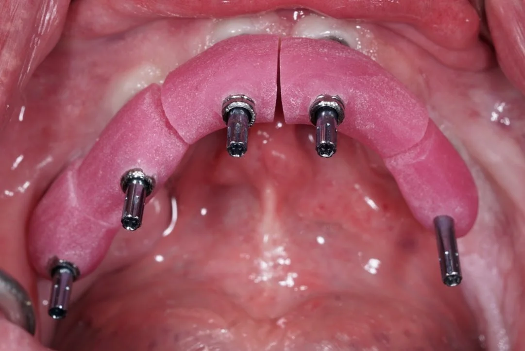Start of something beautiful 😀 
Conventional full arch workflow for a patient who decided to change the initial treatment plan for an implant supported removable denture to a fixed one

#fullarchimplants 
#implantdentistry