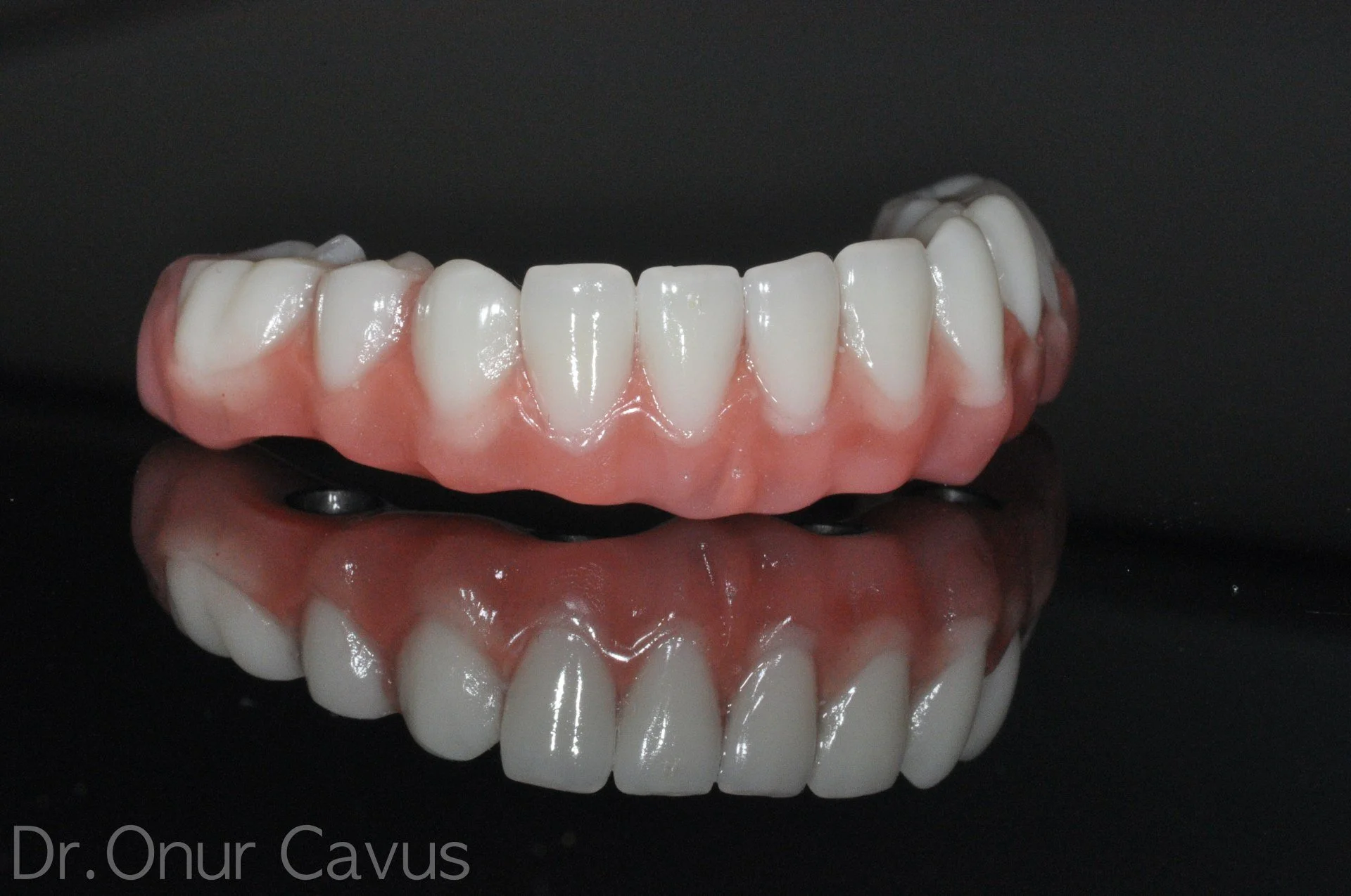 Oral Hygiene and Maintenance for All-on-4 and Full Arch Implants