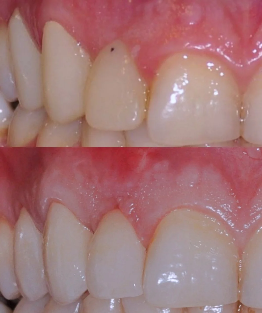 Before and after connective tissue graft and dental bridge restoration replacing a missing tooth.