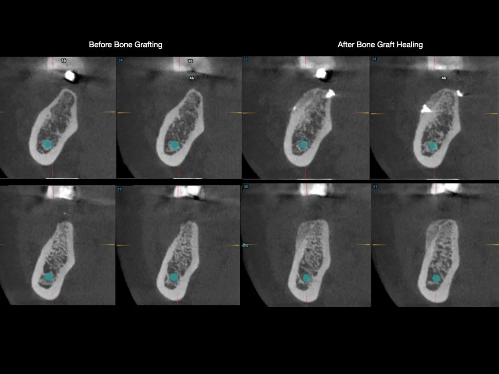 CBCT images showing successful healing after a bone grafting treatent by Dr. Cavus in Toronto.