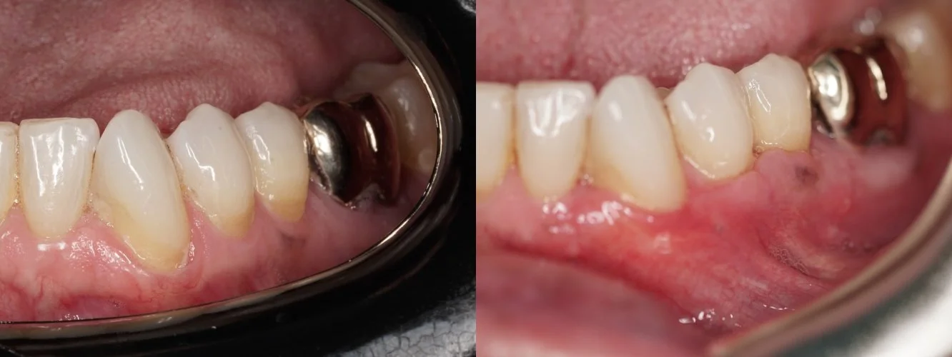 Gum Recession — connective tissue graft