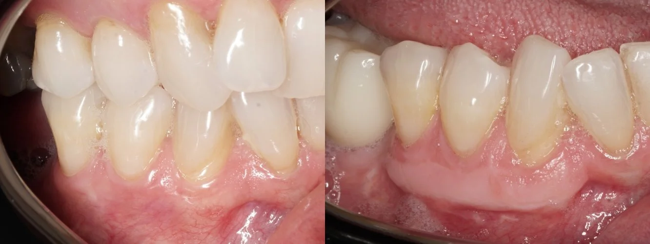 Gum Recession — free gingival graft