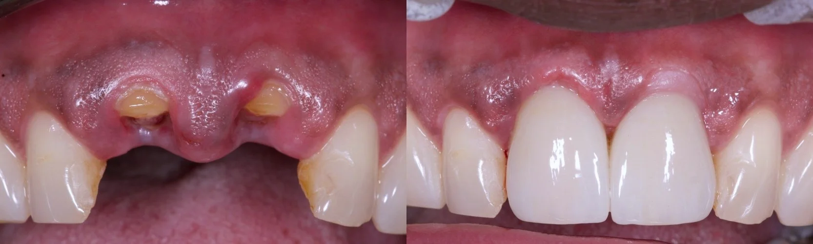 Immediate Implants — anterior esthetic region