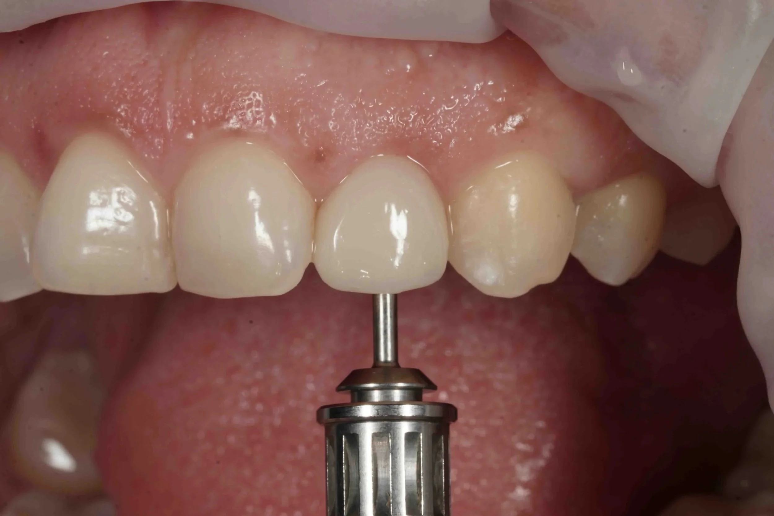 Close-up of a aesthetically successful, natural looking dental implant restoration, replacing a missing upper lateral incisor.