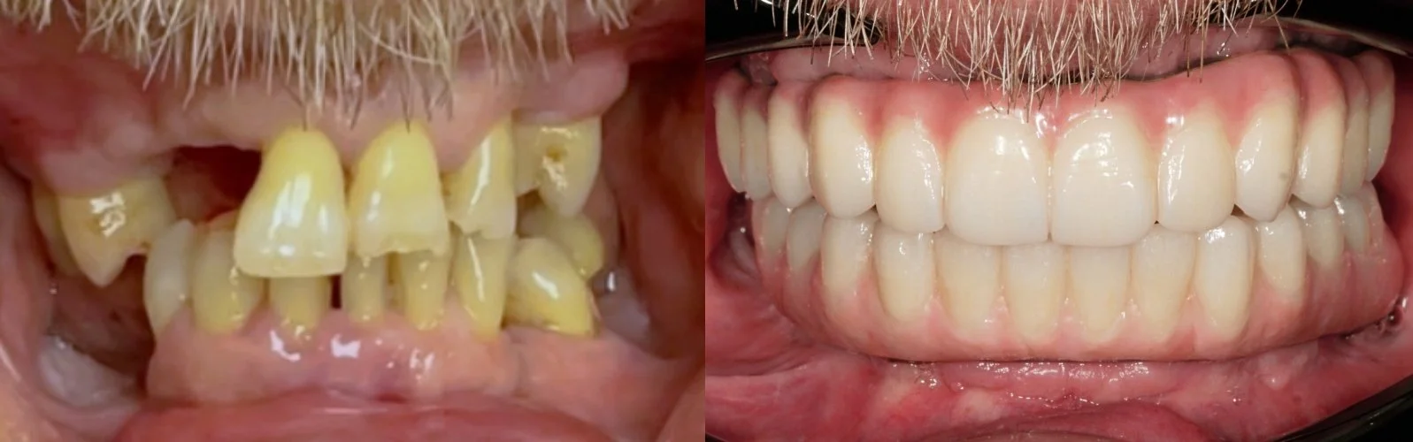 Full Arch All-on-X Implants — upper and lower arch rehabilitation