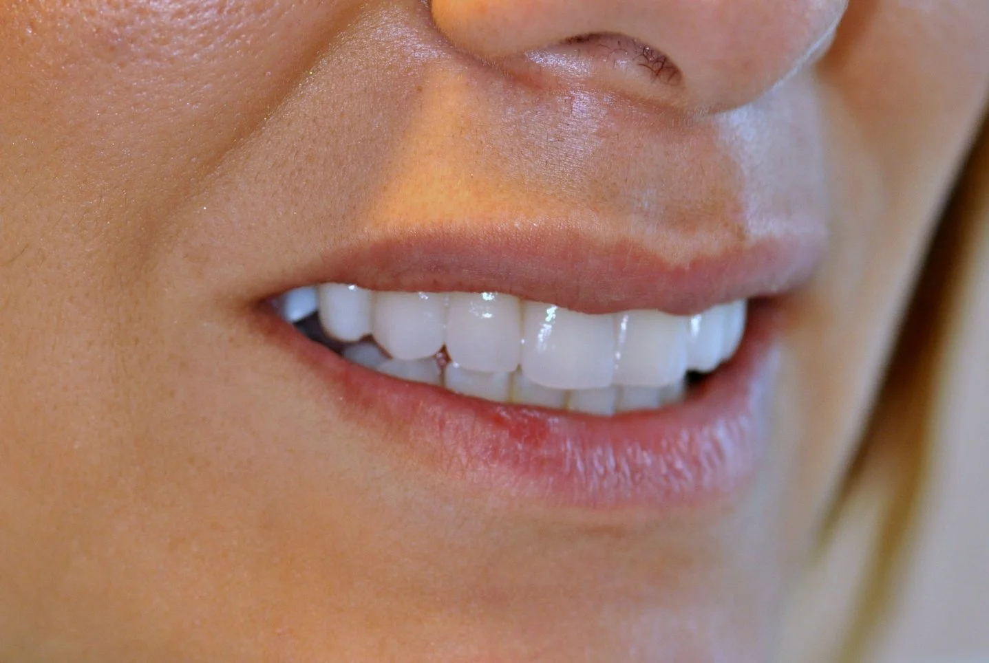 Close-up of a smile enhanced with porcelain veneers at Innova Dental in Toronto.