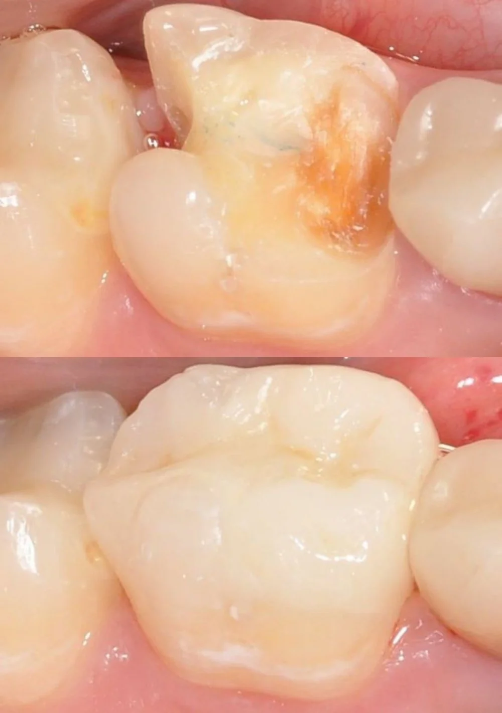 Before and after ceramic inlay restoration used to repair a damaged tooth.
