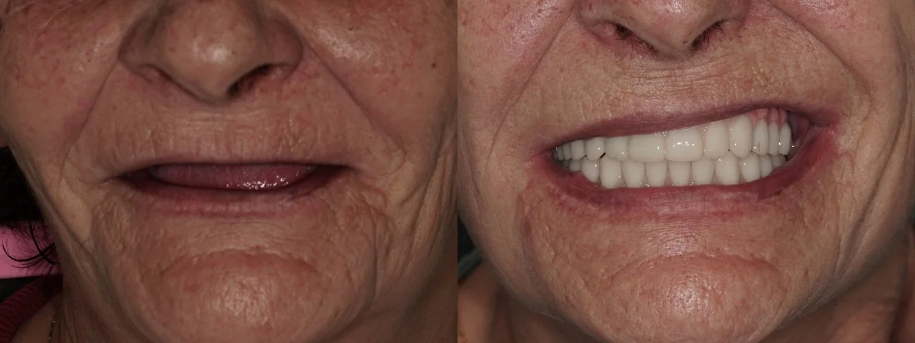
Full Arch All-on-6 Implants