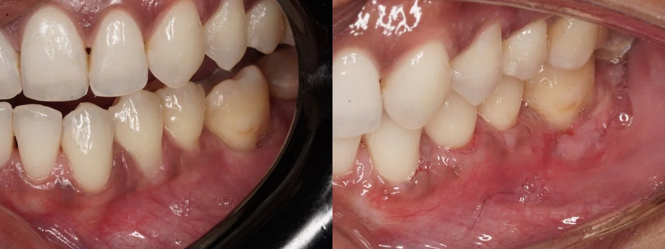 Gum Recession — combined CTG and FGG technique