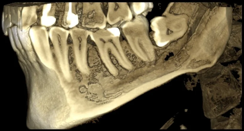 Dr. OnuCBCT scan showing an impacted mandibular wisdom tooth and surrounding jaw anatomy.