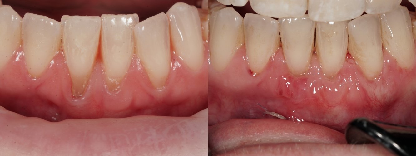 Gum Recession — connective tissue graft