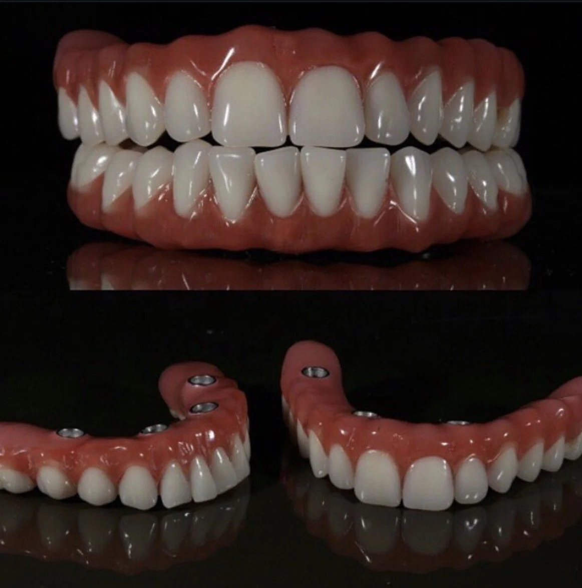 upper and lower full arch dental implants with implant supported hybrid prostheses all on x
