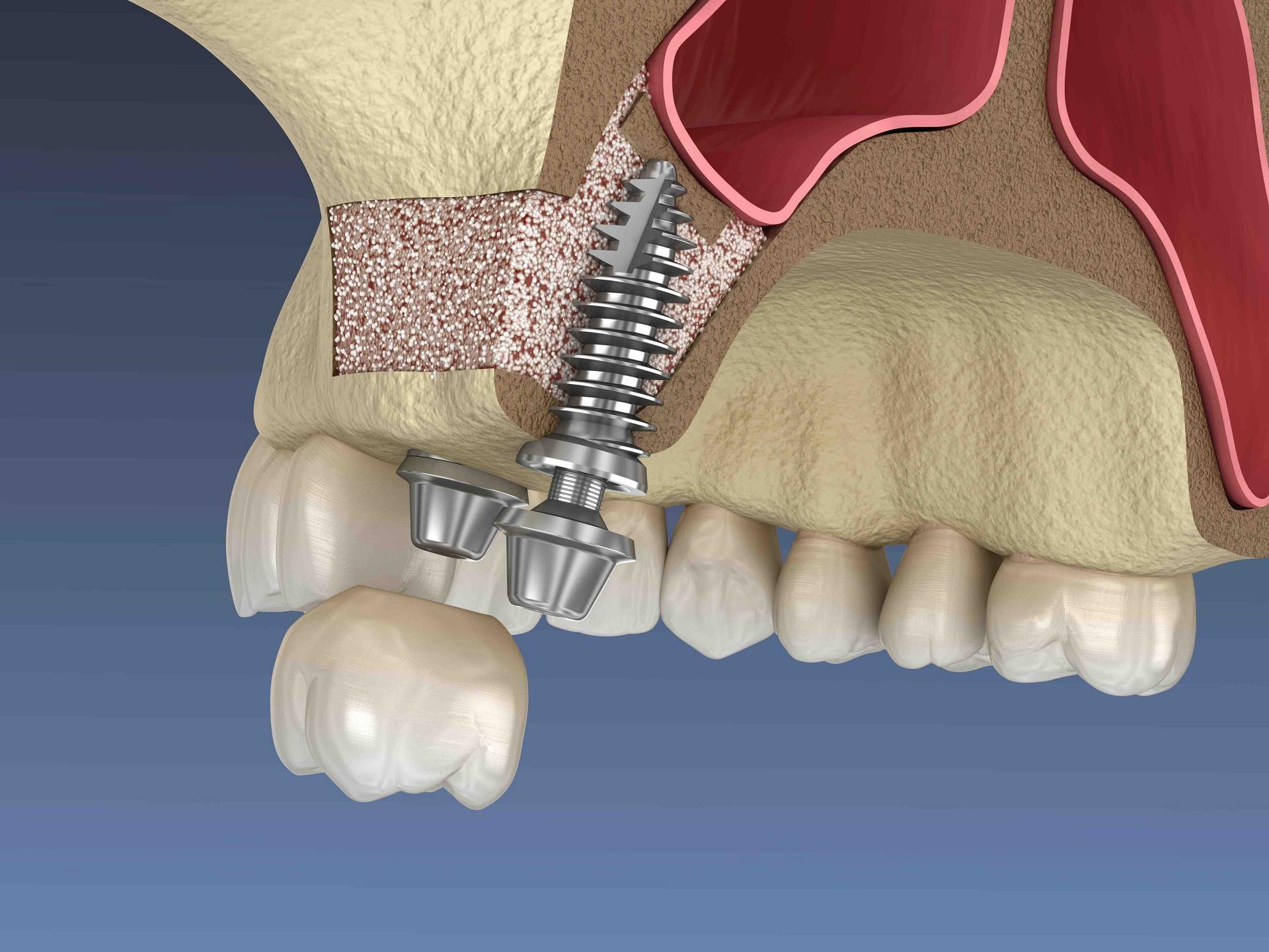 Sinus lift procedure with dental implant placement showing bone graft added to the upper jaw beneath the sinus