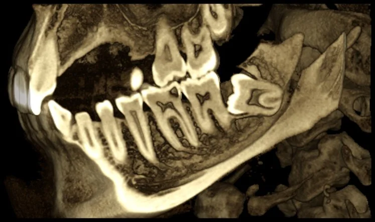 At Innova Dental oral surgery and surgical extraction of impacted wisdom teeth is performed routinely. CBCT scan showing impacted wisdom tooth and surrounding jaw anatomy used for surgical planning.