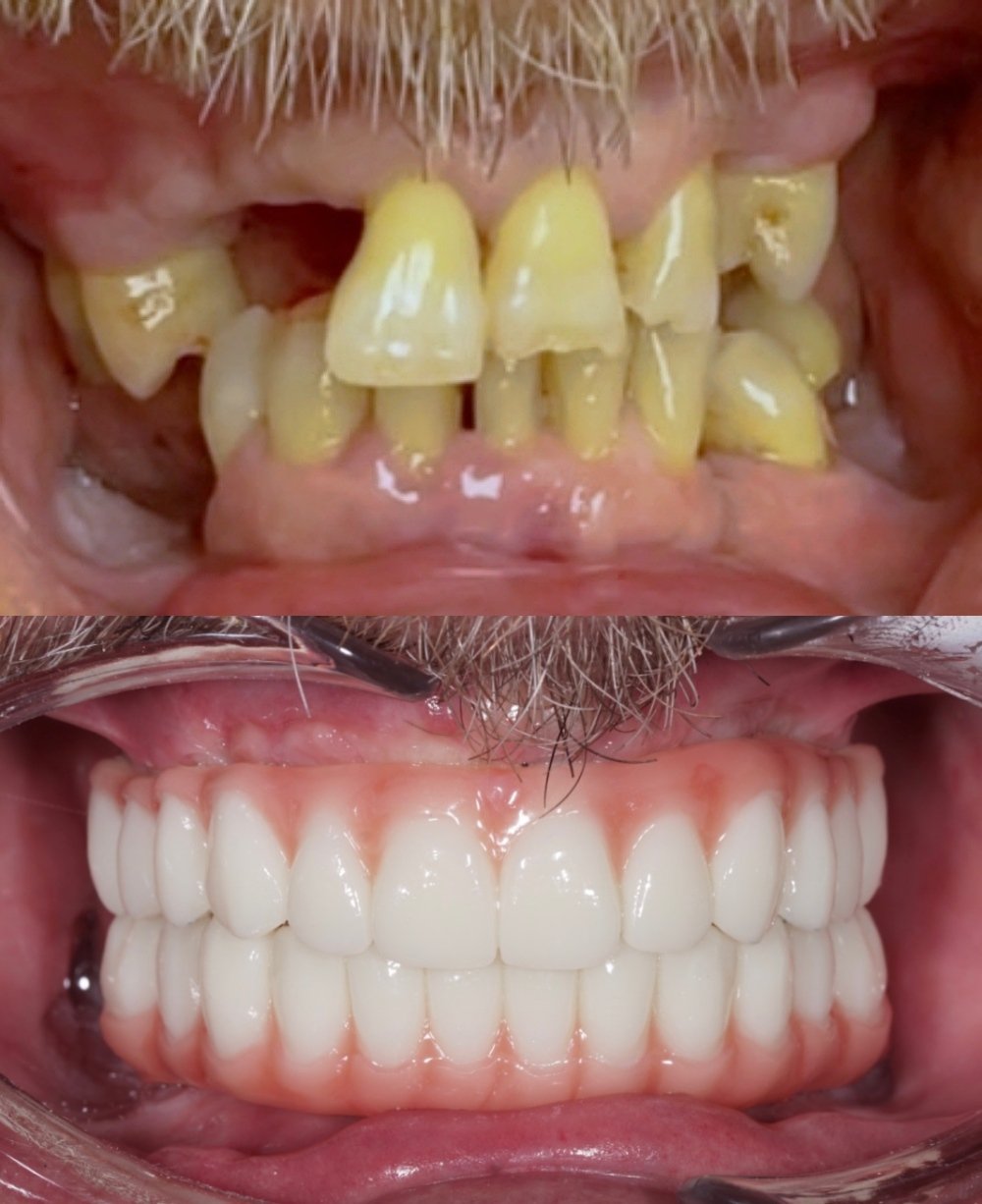 Before and after all-on-x full-arch dental implant restorations replacing severely damaged and missing teeth with a fixed implant-supported prosthesis.