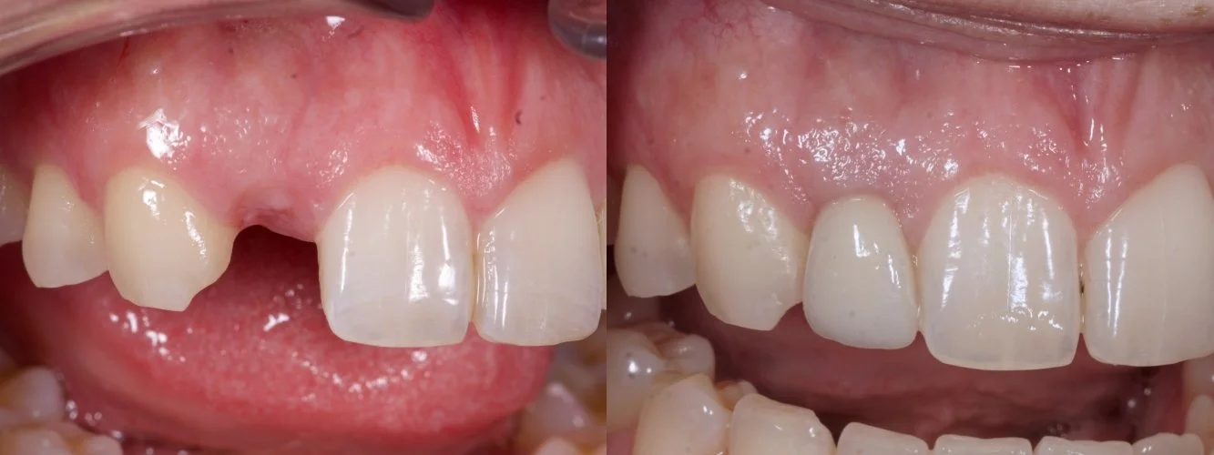 Single Implant — missing lateral incisor, esthetic zone