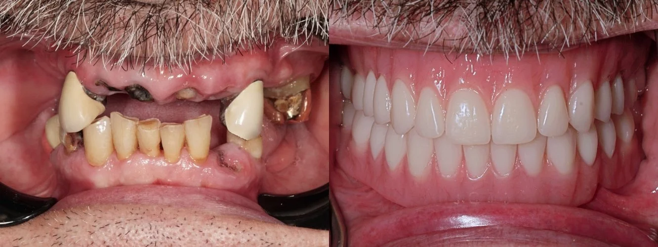 Implant-Retained Overdenture — full arch restoration