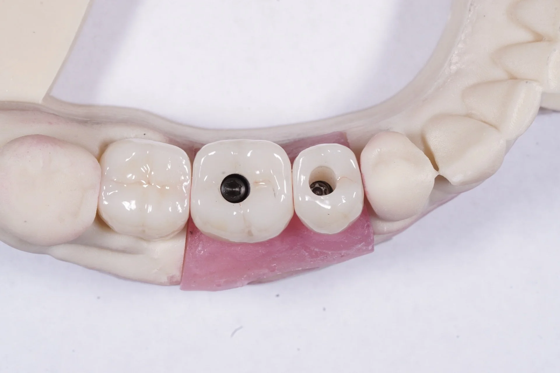 Dental model showing implant-supported crowns used to restore missing posterior teeth