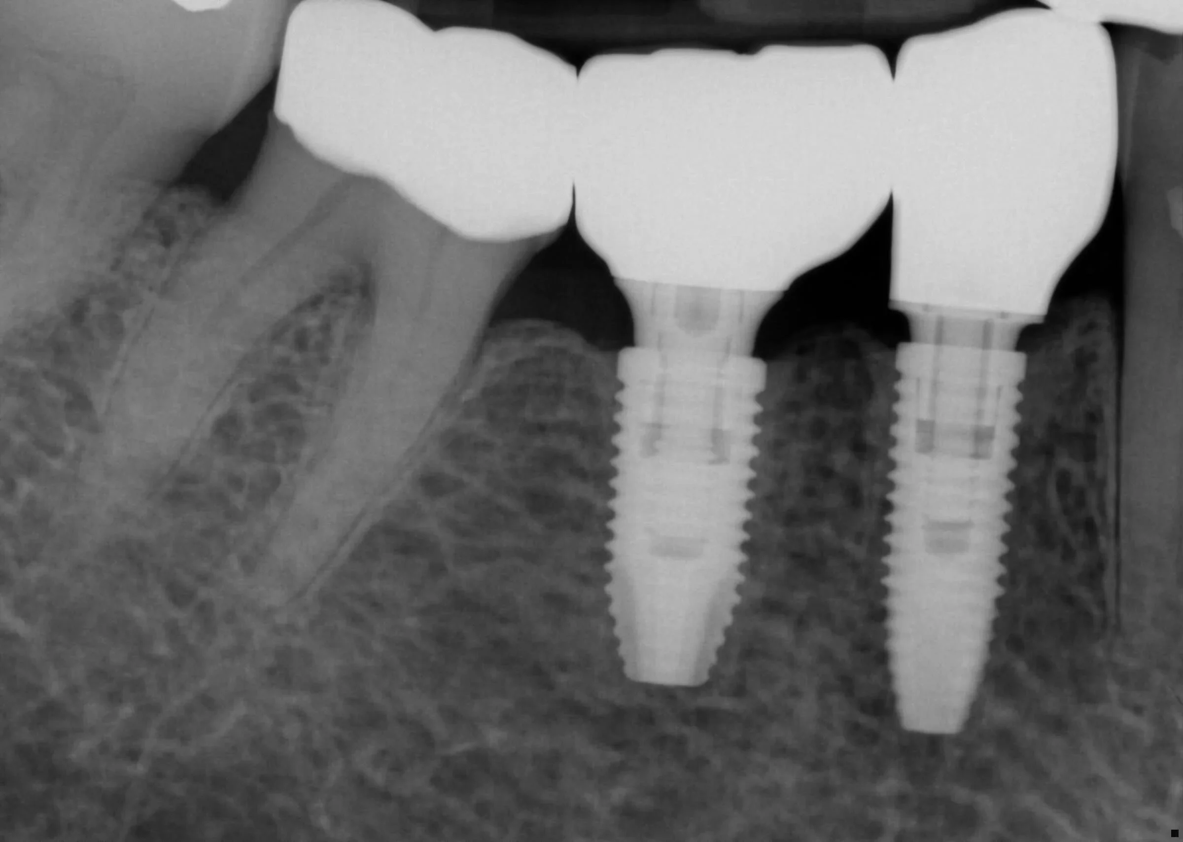 Dental Implants in Toronto: What You Need to Know Before Treatment