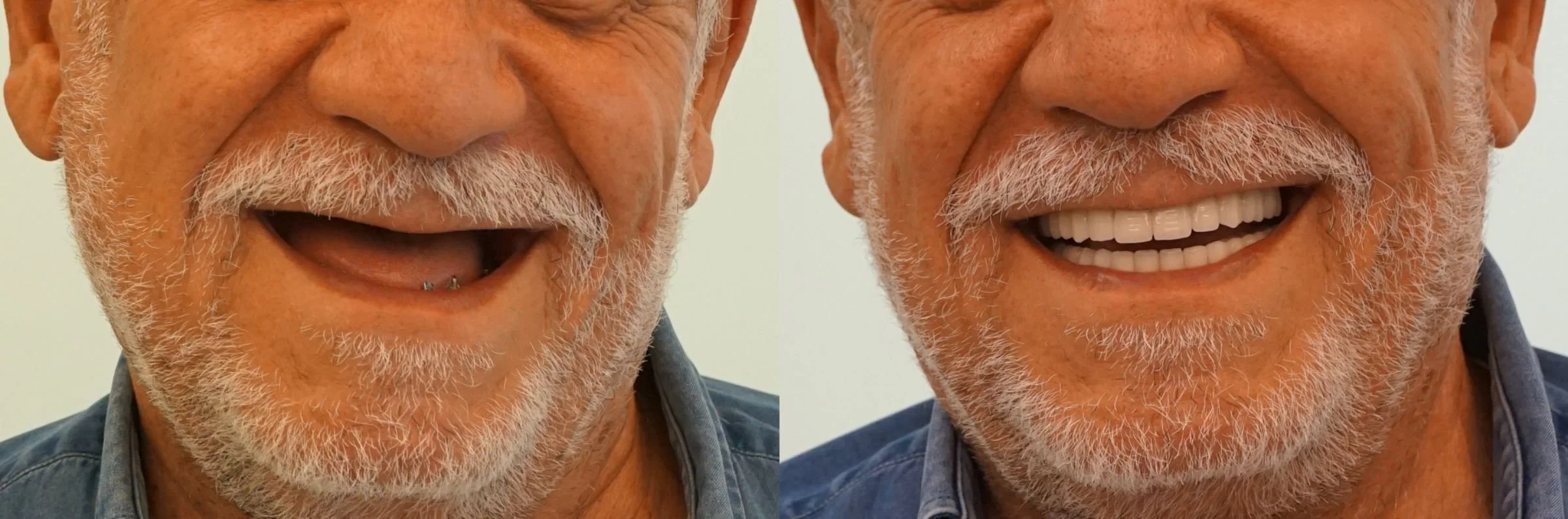 Before and after full-arch dental implant smile restoration showing transformation from missing teeth to a natural-looking fixed implant smile.