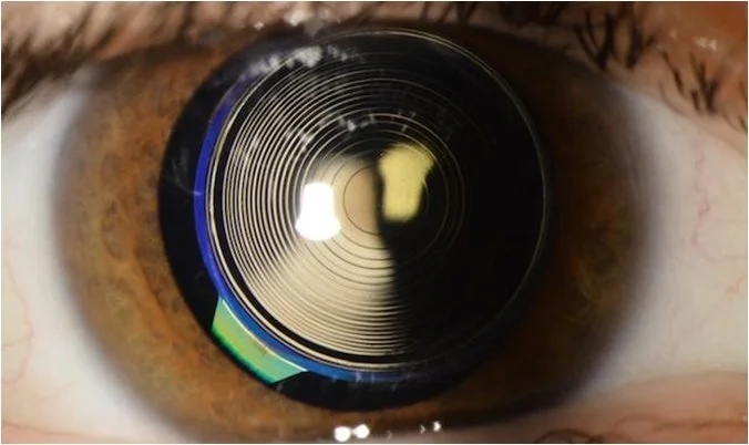 Implant multifocal