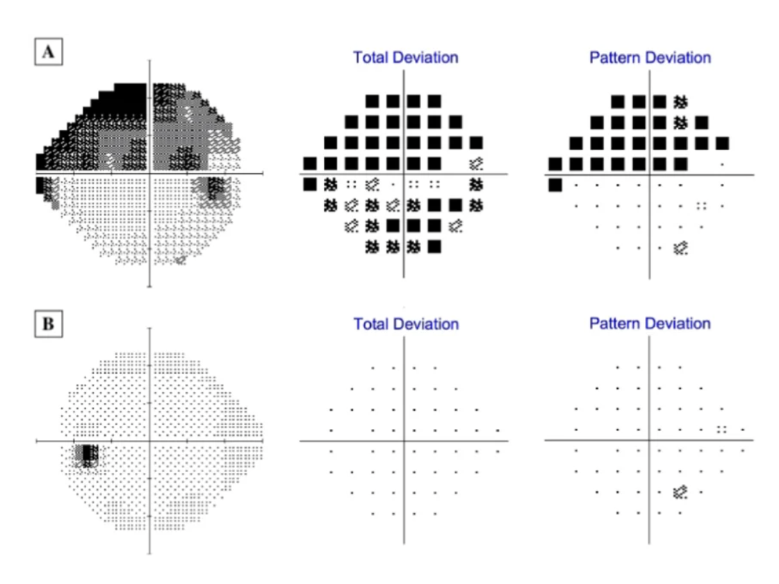 Atteinte du champ visuel en cas de glaucome