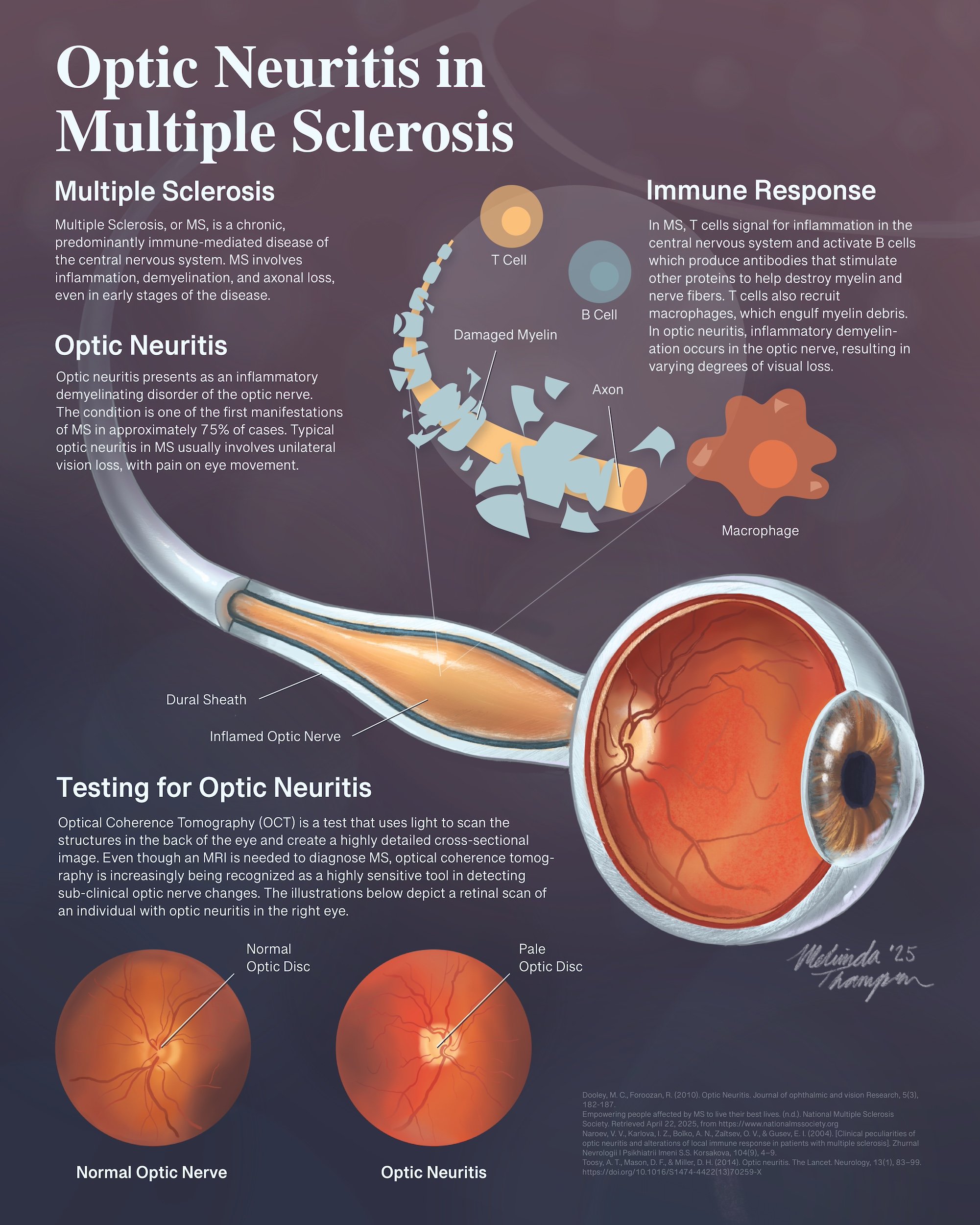 Pathophysiology poster: Optic Neuritis in Multiple Sclerosis