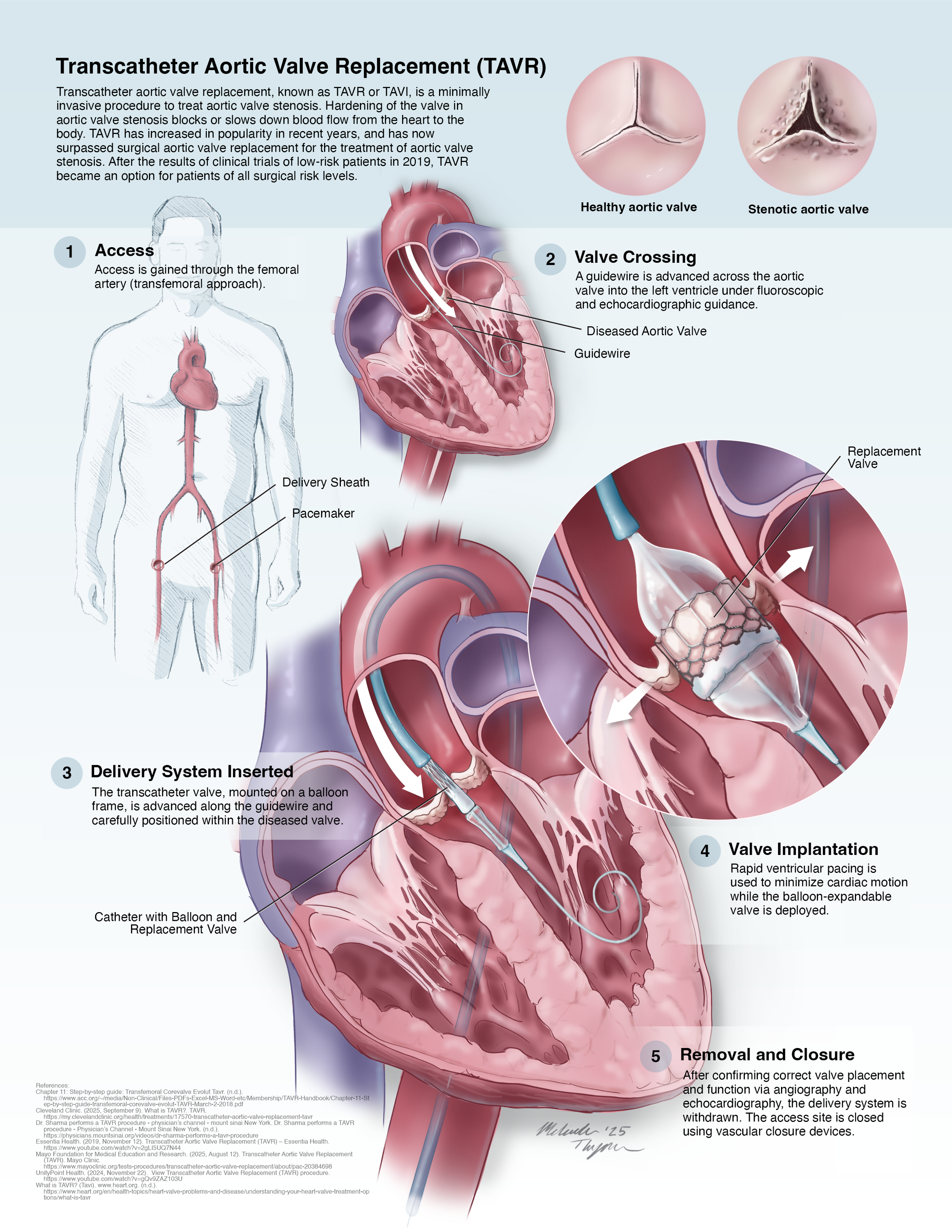 Transcatheter Aortic Valve Replacement - Illustrated Procedure