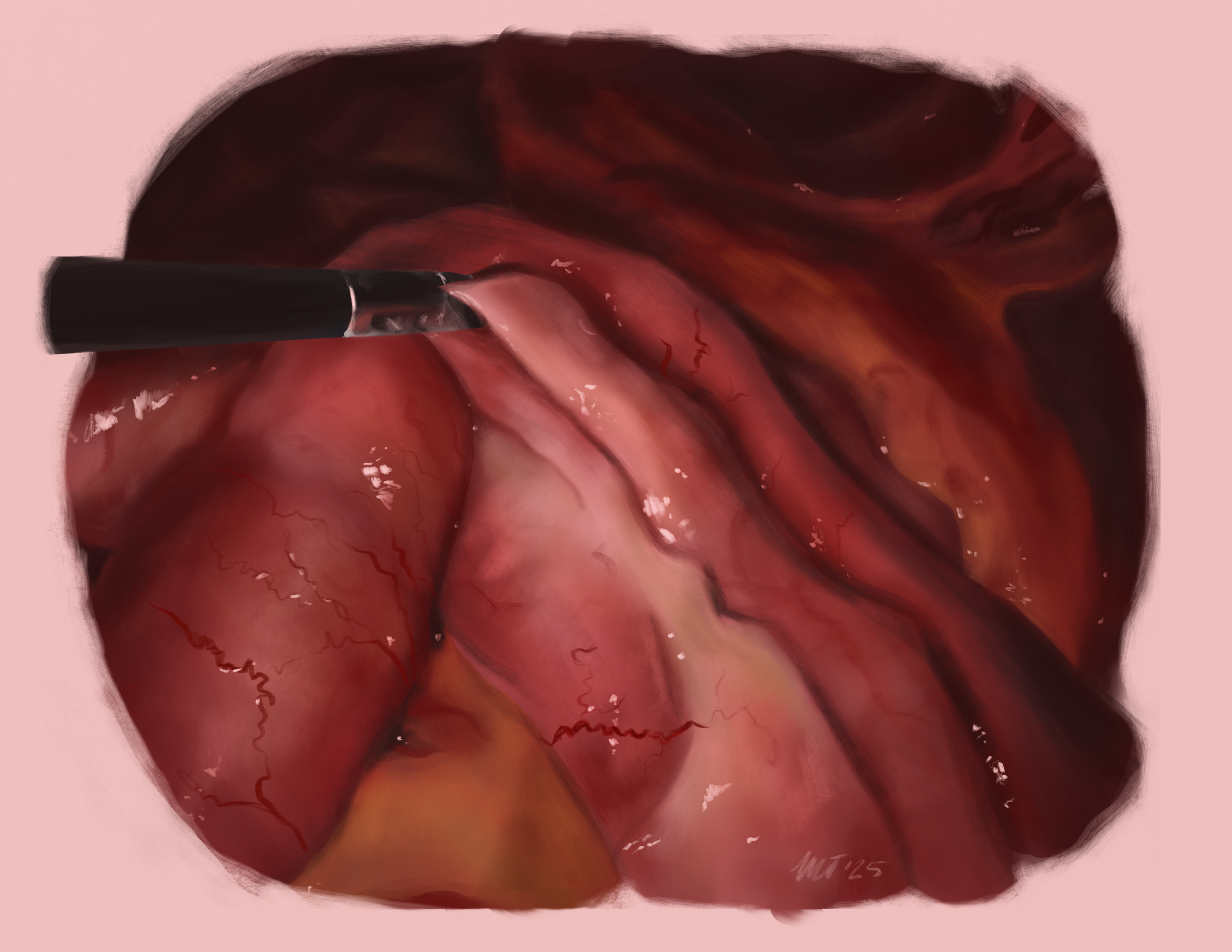 Tissue reaction study: Sleeve gastrectomy to
Roux-en-y gastric bypass conversion