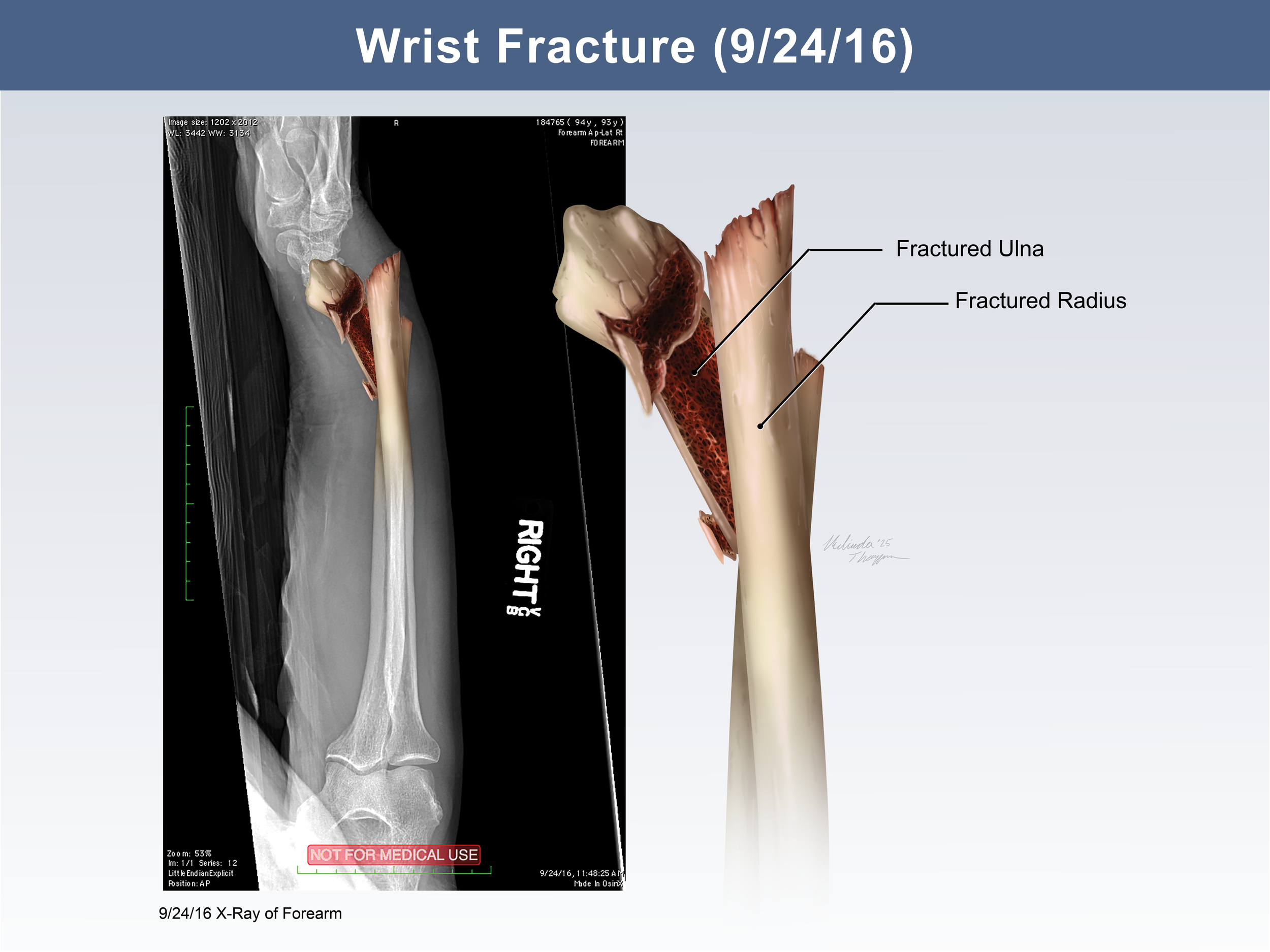 Wrist Fracture: X-Ray Illustration 