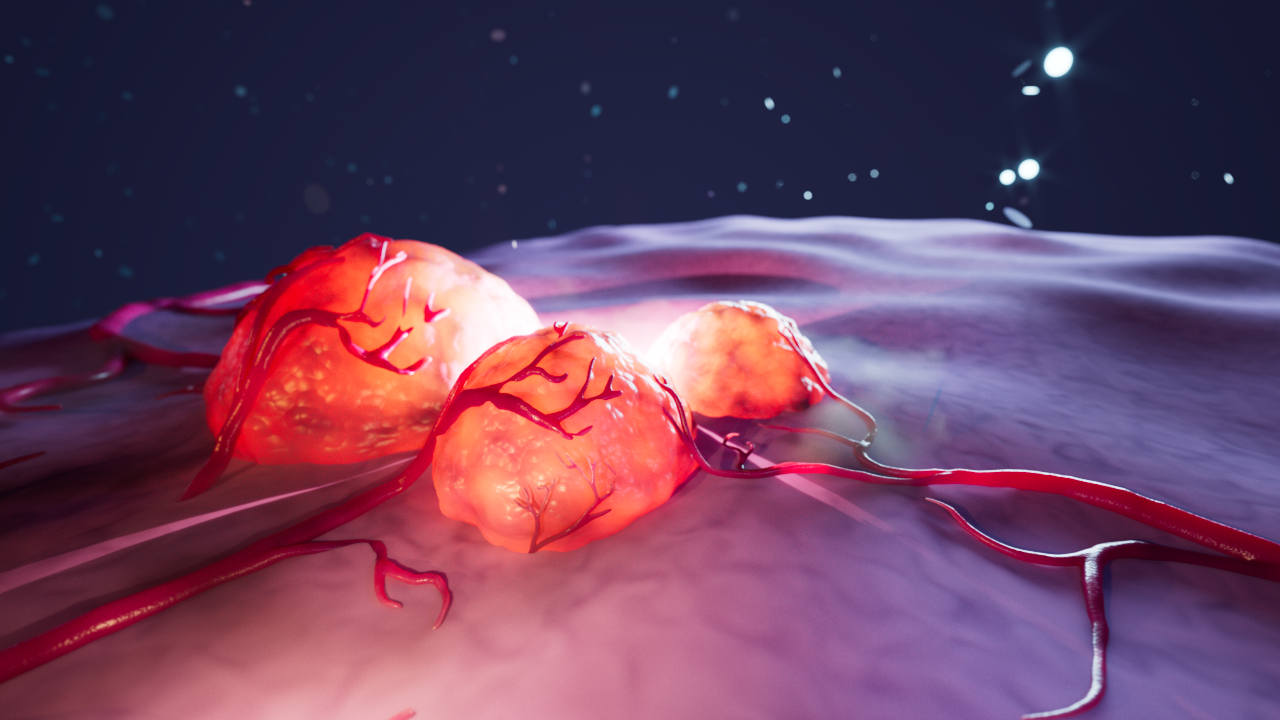 ThompsonM_E3_Tumor (1).png