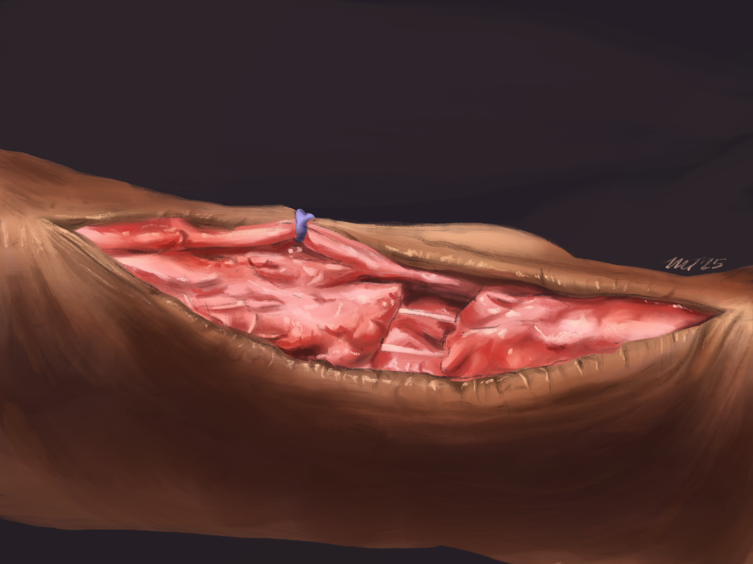 Tissue reaction study: Achilles tendon repair