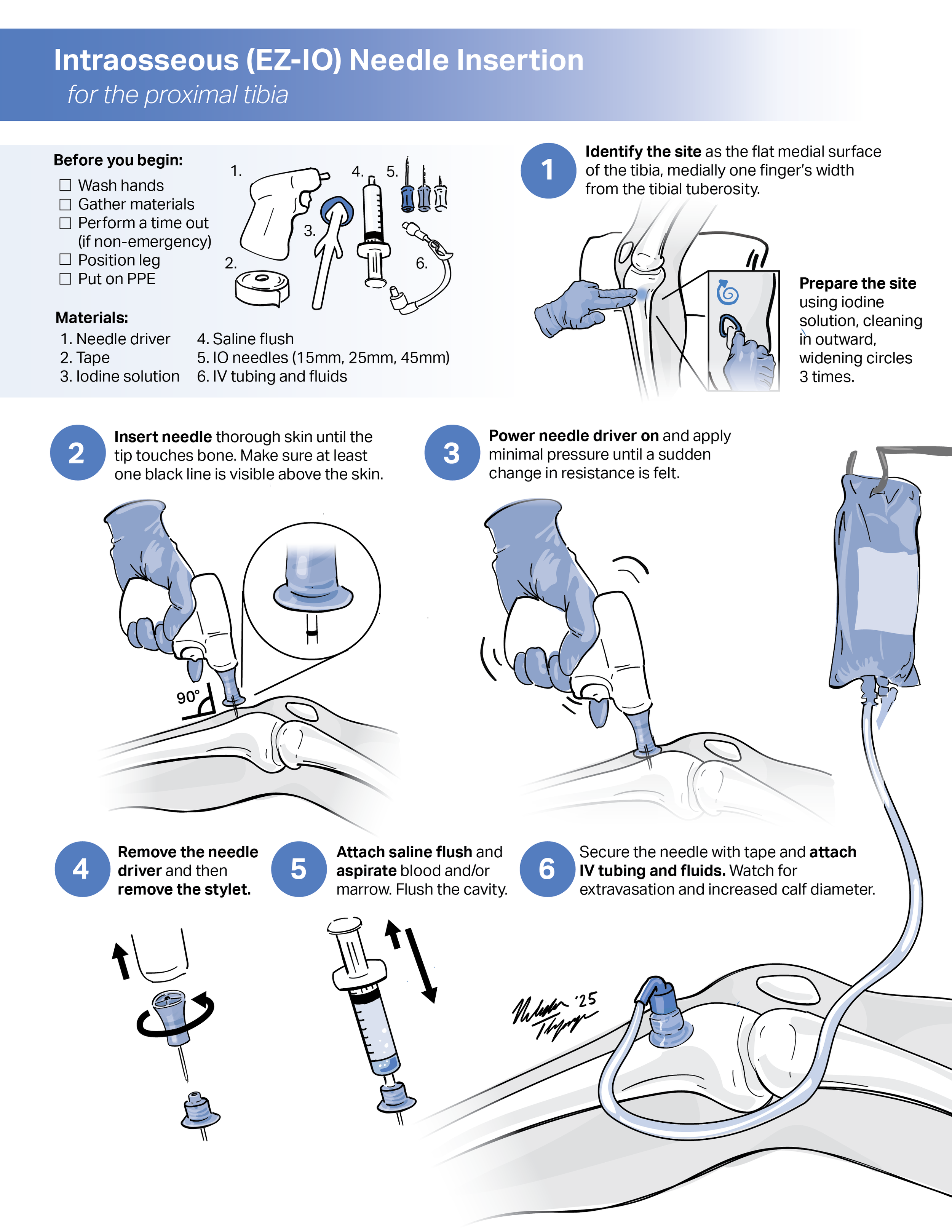 Instructional handout: Intraosseous (EZ-IO) Needle Insertion