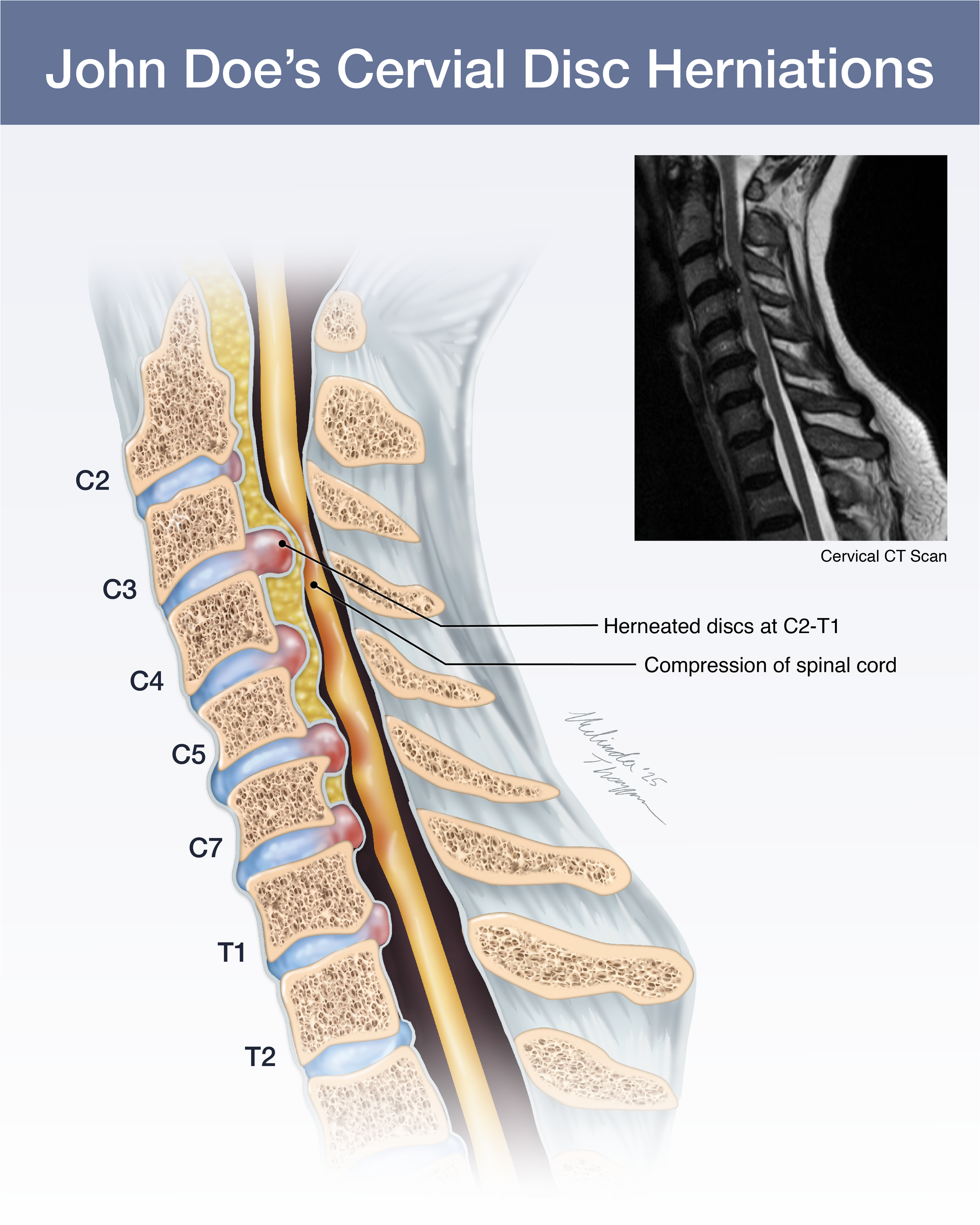 Cervical Disc Herniation: CT Scan Illustration