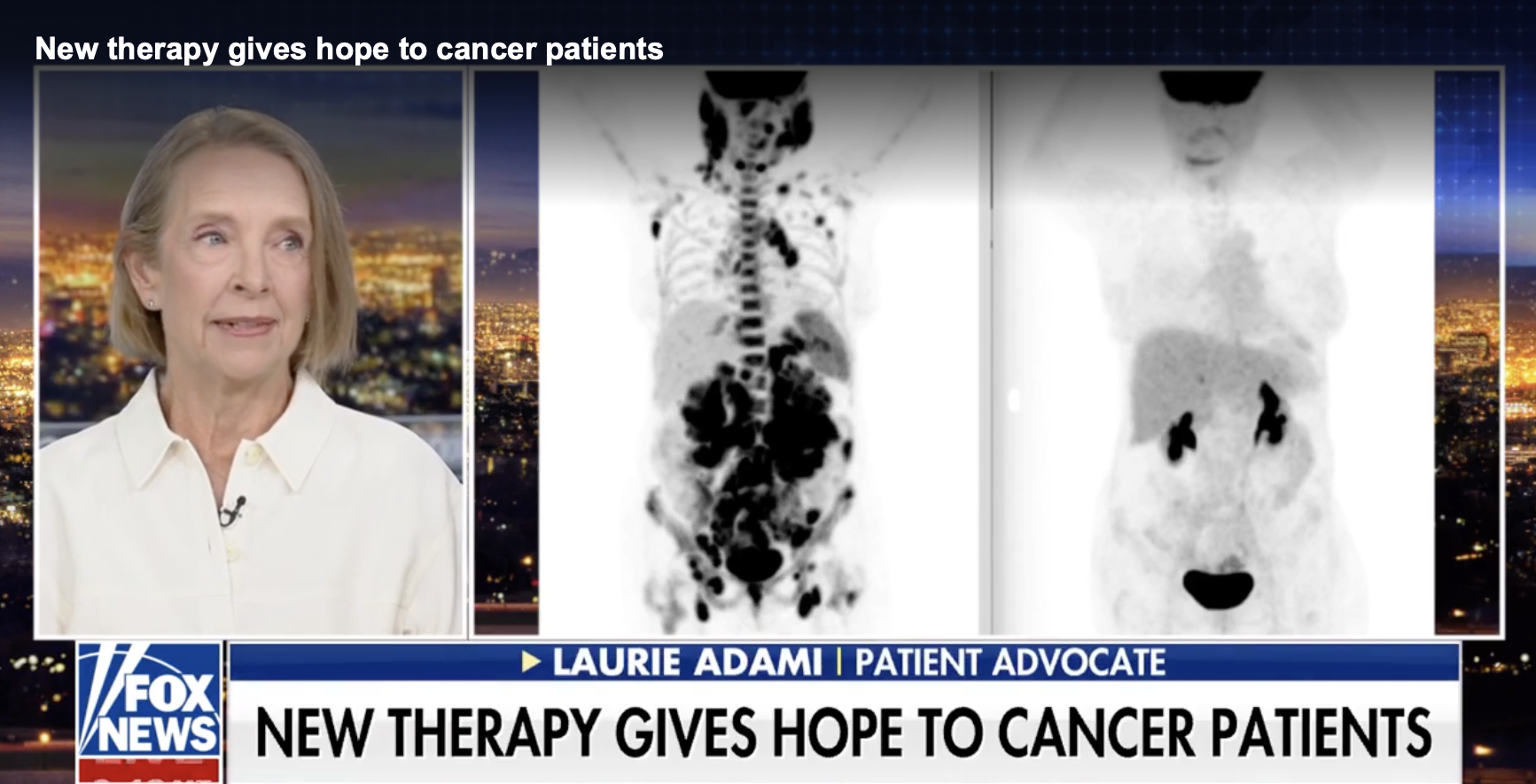 New Therapy gives hope to cancer patients, featured on Fox News